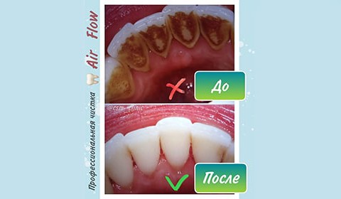 5 признаков того, что пора записаться на профессиональную чистку зубов AIR FLOW в Центр Семейной Медицины